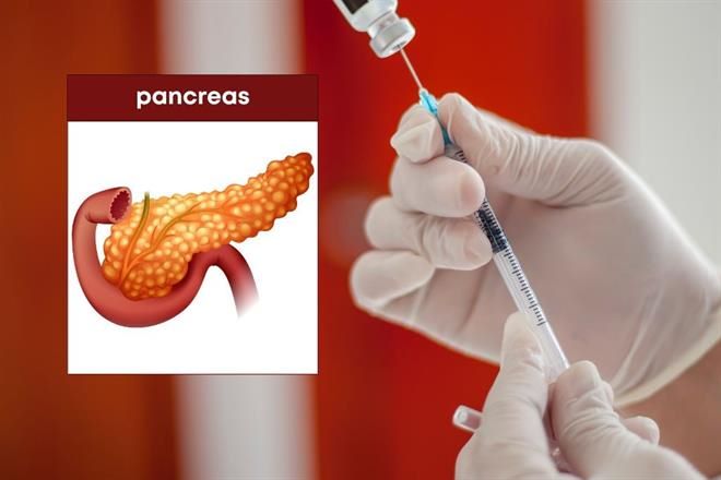 Venciendo al cáncer de páncreas: la prometedora vacuna de ARN